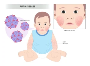 Parvovirus B19: A